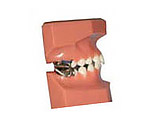 MARA (Mandibular Anterior Repositioning Appliance)