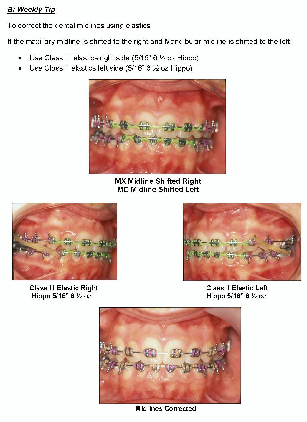 Practice Tip 38 How to correct dental midlines using elastics