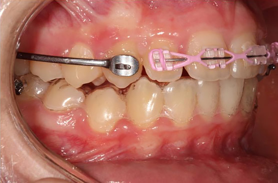 carriere-motion-appliance-class-1-cuspid teeth with Class I Cuspid - 3 Months